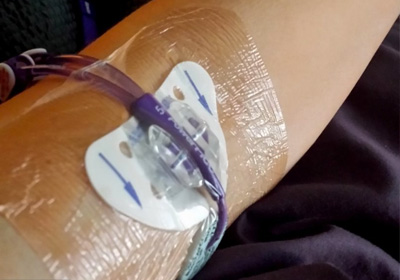 Perfusion et pansements sur chambre implantable (PAC), Picc line Rives